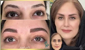 تفاوت میکروبلیدینگ با فیبروز ابرو در چیست؟